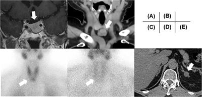 Genotype-negative multiple endocrine neoplasia type 1 with prolactinoma, hyperparathyroidism, and subclinical Cushing’s syndrome accompanied by hyperglycemia: a case report